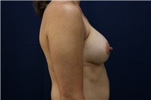 Breast Augmentation After Photo by Lisa Jewell, MD, FACS; Torrance, CA - Case 49209