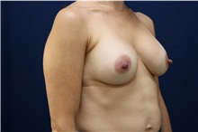 Breast Augmentation After Photo by Lisa Jewell, MD, FACS; Torrance, CA - Case 49209