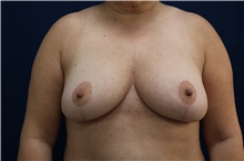 Breast Reduction After Photo by Lisa Jewell, MD, FACS; Torrance, CA - Case 49210