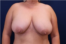 Breast Reduction Before Photo by Lisa Jewell, MD, FACS; Torrance, CA - Case 49210