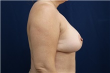 Breast Reduction After Photo by Lisa Jewell, MD, FACS; Torrance, CA - Case 49210