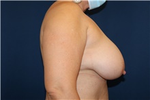 Breast Reduction Before Photo by Lisa Jewell, MD, FACS; Torrance, CA - Case 49210