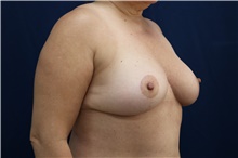 Breast Reduction After Photo by Lisa Jewell, MD, FACS; Torrance, CA - Case 49210