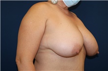 Breast Reduction Before Photo by Lisa Jewell, MD, FACS; Torrance, CA - Case 49210