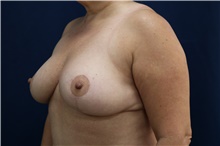 Breast Reduction After Photo by Lisa Jewell, MD, FACS; Torrance, CA - Case 49210