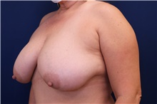 Breast Reduction Before Photo by Lisa Jewell, MD, FACS; Torrance, CA - Case 49210