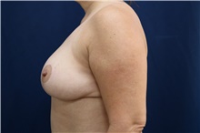 Breast Reduction After Photo by Lisa Jewell, MD, FACS; Torrance, CA - Case 49210