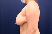 Breast Reduction Before Photo by Lisa Jewell, MD, FACS; Torrance, CA - Case 49210