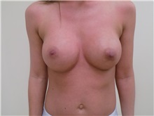 Breast Augmentation After Photo by Jeffrey Antimarino, MD, FACS; Pittsburgh, PA - Case 34357