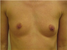 Breast Augmentation Before Photo by Jeffrey Antimarino, MD, FACS; Pittsburgh, PA - Case 34357