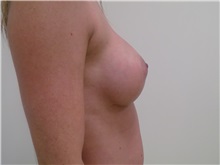 Breast Augmentation After Photo by Jeffrey Antimarino, MD, FACS; Pittsburgh, PA - Case 34357