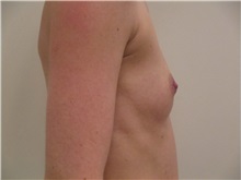 Breast Augmentation Before Photo by Jeffrey Antimarino, MD, FACS; Pittsburgh, PA - Case 34357