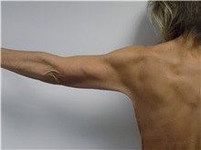 Arm Lift After Photo by Jeffrey Antimarino, MD, FACS; Pittsburgh, PA - Case 34359