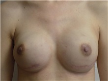 Breast Reconstruction After Photo by Jeffrey Antimarino, MD, FACS; Pittsburgh, PA - Case 34361