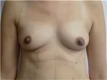 Breast Reconstruction Before Photo by Jeffrey Antimarino, MD, FACS; Pittsburgh, PA - Case 34361