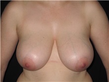 Breast Reduction Before Photo by Jeffrey Antimarino, MD, FACS; Pittsburgh, PA - Case 34362