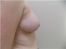 Breast Reduction After Photo by Jeffrey Antimarino, MD, FACS; Pittsburgh, PA - Case 34362