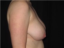 Breast Reduction Before Photo by Jeffrey Antimarino, MD, FACS; Pittsburgh, PA - Case 34362