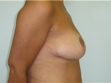 Breast Lift After Photo by Jeffrey Antimarino, MD, FACS; Pittsburgh, PA - Case 34363