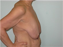 Breast Lift Before Photo by Jeffrey Antimarino, MD, FACS; Pittsburgh, PA - Case 34363