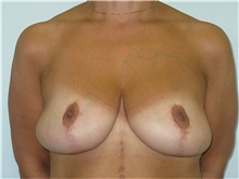 Breast Lift After Photo by Jeffrey Antimarino, MD, FACS; Pittsburgh, PA - Case 34363