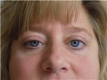 Eyelid Surgery After Photo by Jeffrey Antimarino, MD, FACS; Pittsburgh, PA - Case 34364