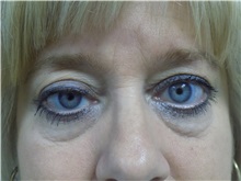 Eyelid Surgery Before Photo by Jeffrey Antimarino, MD, FACS; Pittsburgh, PA - Case 34364