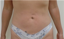 Liposuction After Photo by Jeffrey Antimarino, MD, FACS; Pittsburgh, PA - Case 34365