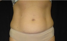 Liposuction Before Photo by Jeffrey Antimarino, MD, FACS; Pittsburgh, PA - Case 34365