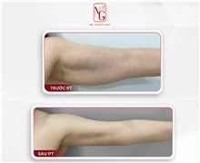 Arm Lift After Photo by Tran Nguyen Giap, MD; Phu Nhuan,  - Case 50248