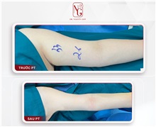 Arm Lift Before Photo by Tran Nguyen Giap, MD; Phu Nhuan,  - Case 50248