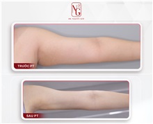 Arm Lift After Photo by Tran Nguyen Giap, MD; Phu Nhuan,  - Case 50248