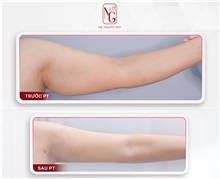 Arm Lift Before Photo by Tran Nguyen Giap, MD; Phu Nhuan,  - Case 50248