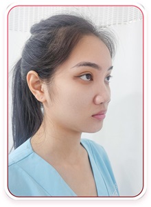 Rhinoplasty Before Photo by Tran Nguyen Giap, MD; Phu Nhuan,  - Case 50245