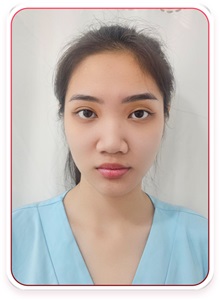 Rhinoplasty Before Photo by Tran Nguyen Giap, MD; Phu Nhuan,  - Case 50245