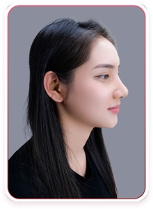 Rhinoplasty After Photo by Tran Nguyen Giap, MD; Phu Nhuan,  - Case 50245