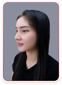 Rhinoplasty After Photo by Tran Nguyen Giap, MD; Phu Nhuan,  - Case 50245