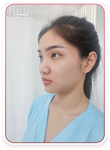Rhinoplasty Before Photo by Tran Nguyen Giap, MD; Phu Nhuan,  - Case 50245