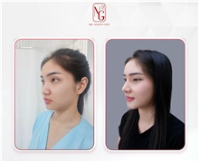 Rhinoplasty After Photo by Tran Nguyen Giap, MD; Phu Nhuan,  - Case 50245