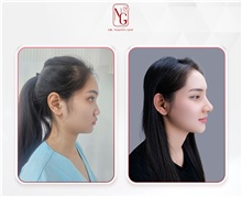 Rhinoplasty Before Photo by Tran Nguyen Giap, MD; Phu Nhuan,  - Case 50245