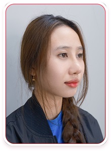Rhinoplasty After Photo by Tran Nguyen Giap, MD; Phu Nhuan,  - Case 50244