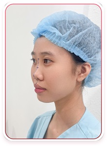 Rhinoplasty Before Photo by Tran Nguyen Giap, MD; Phu Nhuan,  - Case 50244