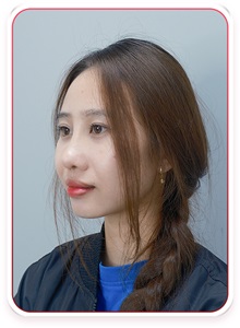 Rhinoplasty After Photo by Tran Nguyen Giap, MD; Phu Nhuan,  - Case 50244