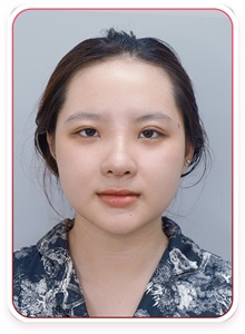 Rhinoplasty After Photo by Tran Nguyen Giap, MD; Phu Nhuan,  - Case 50249