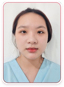 Rhinoplasty Before Photo by Tran Nguyen Giap, MD; Phu Nhuan,  - Case 50249