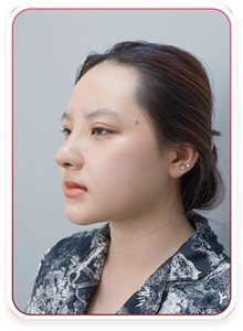 Rhinoplasty After Photo by Tran Nguyen Giap, MD; Phu Nhuan,  - Case 50249