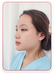 Rhinoplasty Before Photo by Tran Nguyen Giap, MD; Phu Nhuan,  - Case 50249