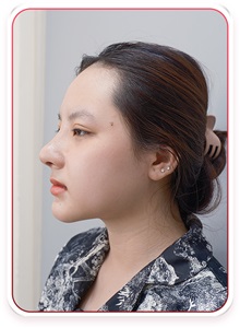 Rhinoplasty After Photo by Tran Nguyen Giap, MD; Phu Nhuan,  - Case 50249