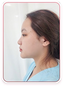 Rhinoplasty Before Photo by Tran Nguyen Giap, MD; Phu Nhuan,  - Case 50249