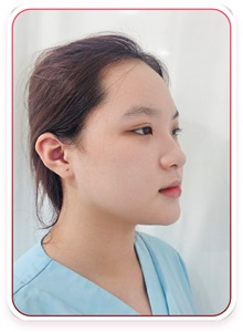 Rhinoplasty Before Photo by Tran Nguyen Giap, MD; Phu Nhuan,  - Case 50249